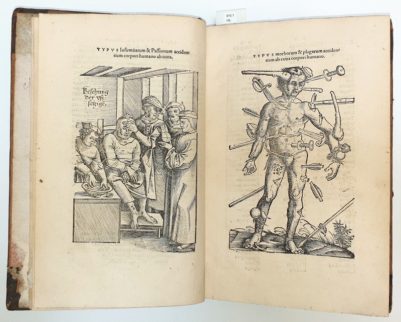 Open 15th-century surgical book showing a medical procedure on the left page and a 'wound man' illustration on the right, displaying various weapon injuries on a human figure.